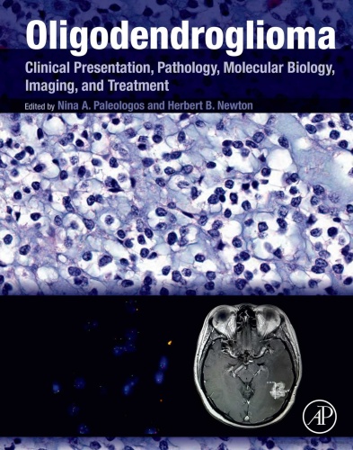 Oligodendroglioma Clinical Presentation, Pathology, Molecular Biology, Imaging,